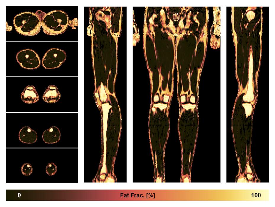 The fat fraction of the lower extremity obtained from the dixon reconstruction for muscle water fat quantification.